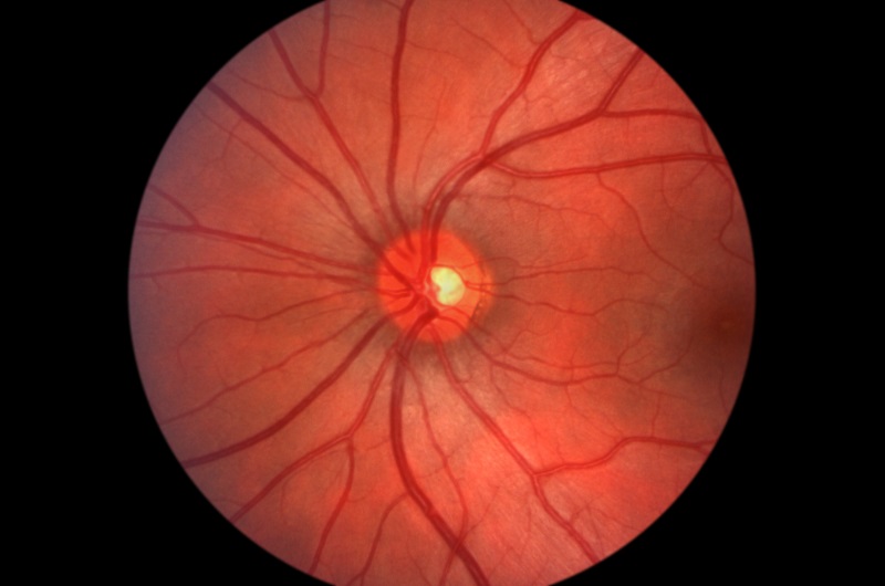 Glaucoma Care